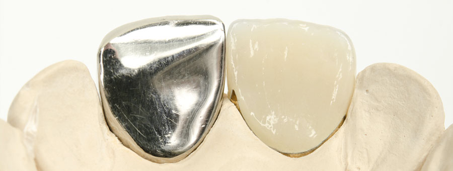 東京都港区青山の歯医者 金銀パラジウム合金・ニッケルクロム合金