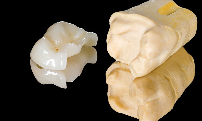 東京都港区青山の歯医者 セラミックインレー