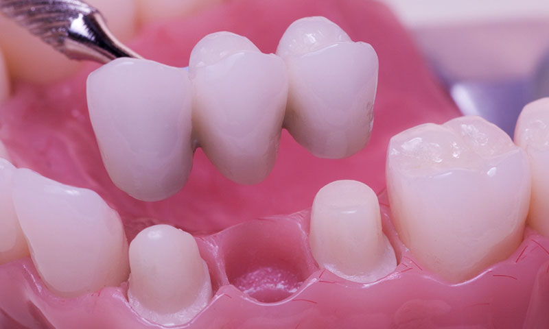 東京都港区青山の歯医者 ブリッジ