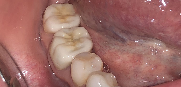 東京都港区青山の歯医者 プレスセラミッククラウン