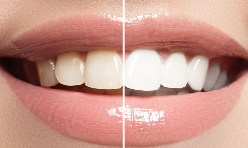 東京都港区青山の歯医者 ホームホワイトニング